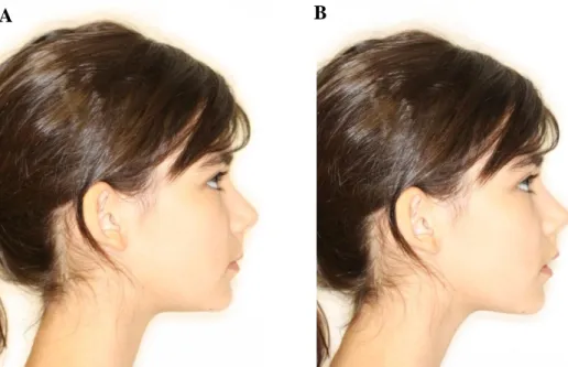 Figura 12 - Fotografias extra-orais de perfil do Caso Clínico 1: A – PIM; B - Repouso 