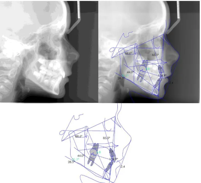 Tabela 9 - Tabela de resultados da análise resumida de Ricketts do Caso Clínico 1  Figura 13 - Telerradiografia lateral e Cefalometria resumida de Ricketts do Caso Clínico 1 