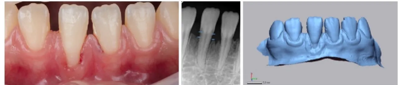 Figura  25  -  Fotografia  intraoral,  em  T0,  da  RG.  Radiografia  periapical  do  dente  intervencionado