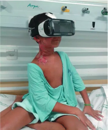 Figure 1 –  Child using virtual reality goggles while waiting  for dressing closure, Florianópolis, Santa  Cata-rina, Brazil, 2016