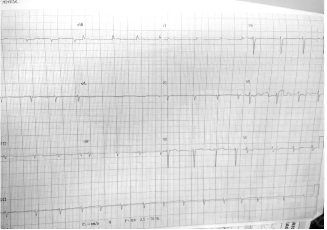 Figura 1 - Eletrocardiograma (ECG): Padrão de Fibrilação Atrial, com áreas de  baixa voltagem
