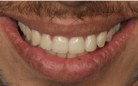 Figura 1. Aspecto inicial do sorriso e dos dentes na visão extrabucal. 