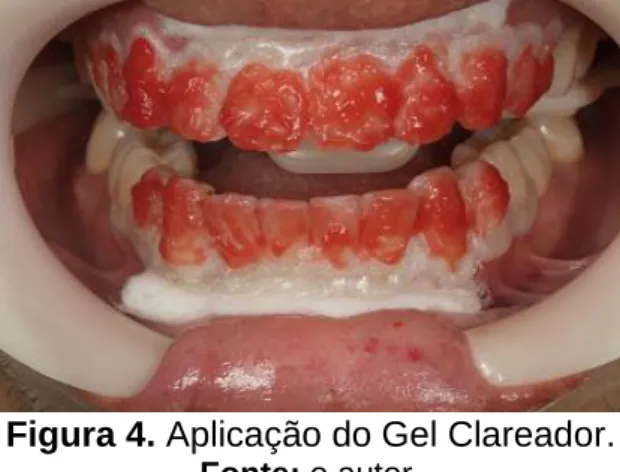 Figura 4. Aplicação do Gel Clareador. 