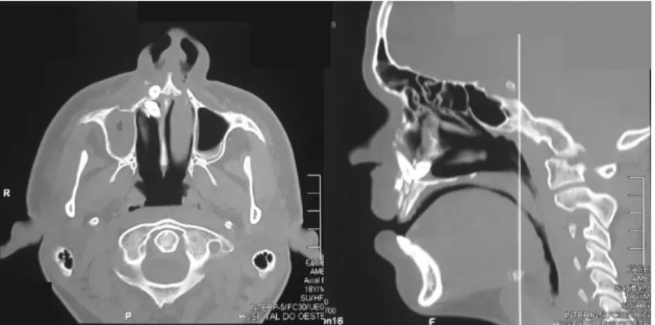 Figura 4 – Tomografia computadorizada evidenciando unidades dentárias em  cavidade nasal