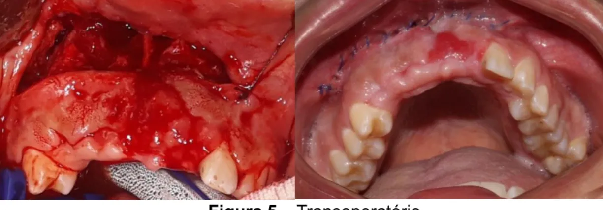 Figura 6 – Unidades dentárias após remoção cirúrgica. 