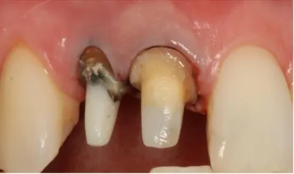 Figura 7 - Remanescente dentário após preparo. 