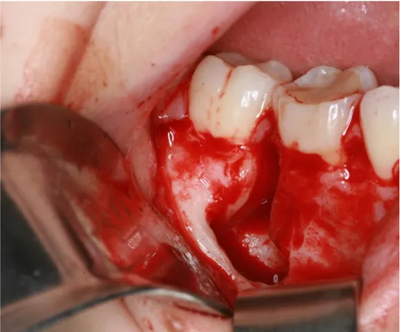 Figura 3 - Aspecto da loja cirúrgica após enucleação da lesão e apicectomia da  raiz distal do dente 46