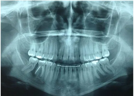 Figura 7 - Radiografia Panorâmica de 03 meses pós-operatório, apresentando  sutil formação óssea na região do dente 46