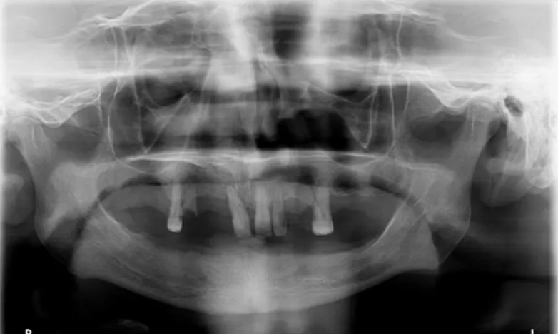 Figura 4 - Radiografia panorâmica. Presença de restos radiculares e  reabsorção óssea horizontal na maxila