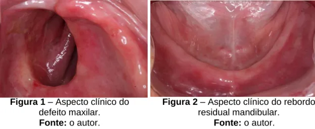 Figura 1 – Aspecto clínico do  defeito maxilar. 