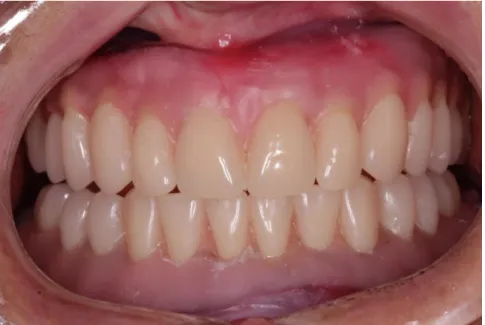 Figura 6 – Montagem dos dentes em  cera para prova em boca. 
