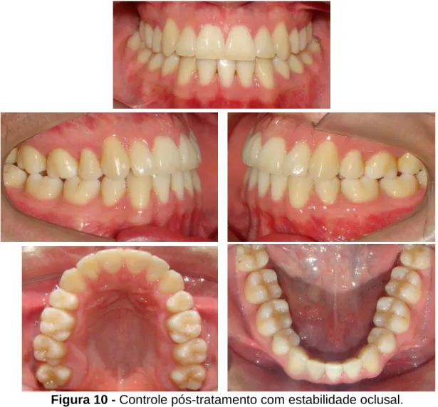 Figura 10 - Controle pós-tratamento com estabilidade oclusal. 