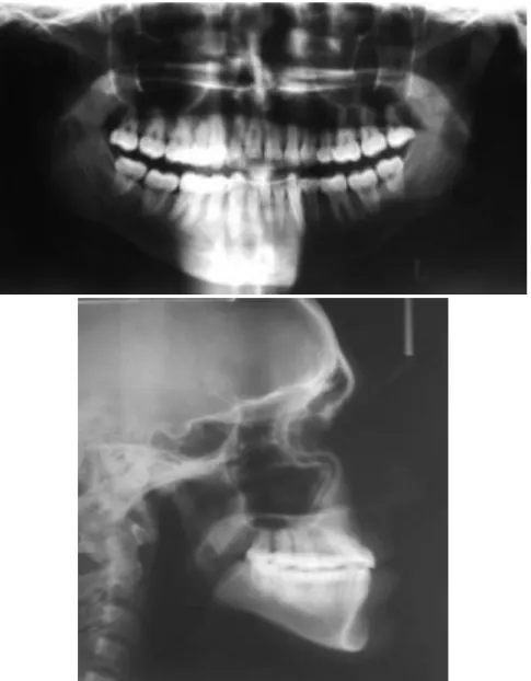 Figura 7 – Radiografia panorâmica e telerradiografia após o tratamento  ortodôntico. 