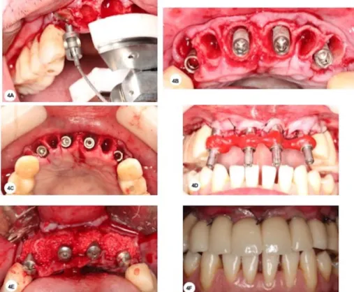 Figura 4 – (A) Remoção do elemento dentário 13 com extrator de dentário; (B  e  C)  Implantes  instalados  nos  alvéolos  13,  11,  21  e  23;  (D)  Moldagem  de  transferência; (E) Preenchimento dos defeitos ósseos com  β-Tricálcio Fosfato; 