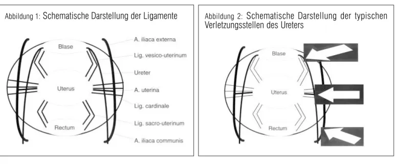 Abbildung 1:  Schematische Darstellung der Ligamente Abbildung 2:  Schematische Darstellung der typischen