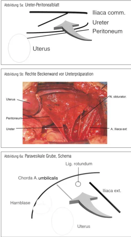 Abbildung 5a:  Ureter-Peritonealblatt