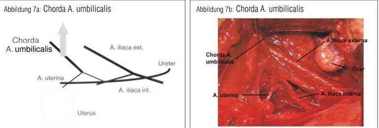 Abbildung 7a:  Chorda A. umbilicalis Abbildung 7b:  Chorda A. umbilicalis