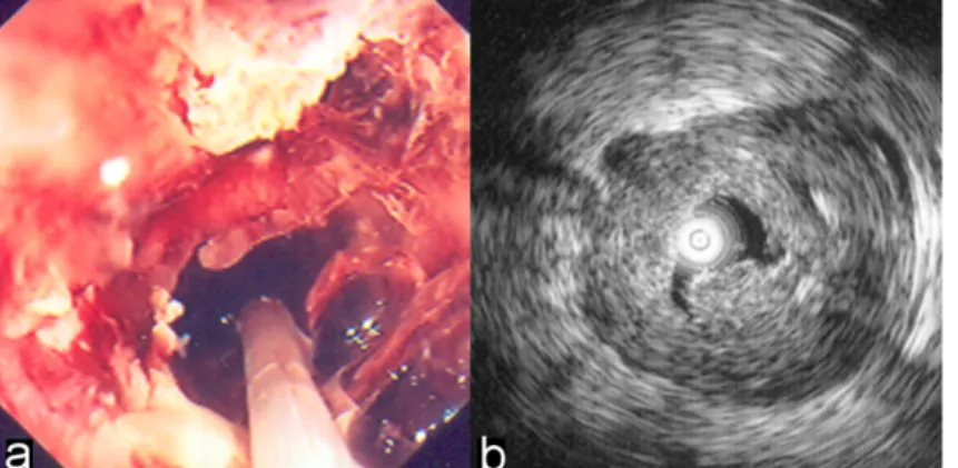 Fig. 1. Stenosing RC. A. Observation by colonoscopy with a miniprobe inserted in the lumen.