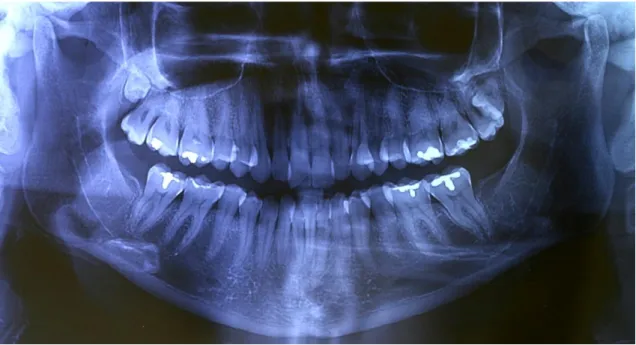 Figura 1- Radiografia panorâmica inicial, evidenciando a existência de dois quartos molares  em maxila