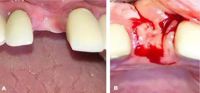 Figura 2- A- Mostrando aspecto clínico após 110 dias de cicatrização pós exodontia. 