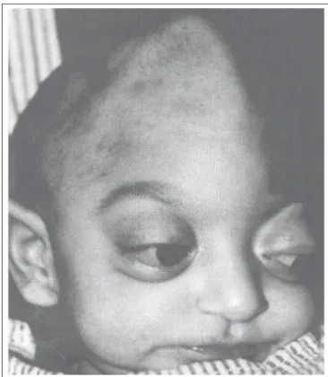 Figure 1 - Craniofacial Deformity (Craniosynostosis, retrognathism and bilateral exophthalmus)