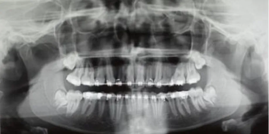 Figura  4  -  Aproximação  dos  Incisivos  da  radiografia  Panorâmica.  