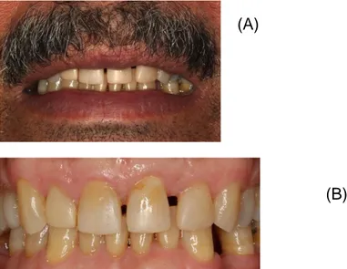 Figura 1- Vista inicial, sorriso do paciente e presença de diastemas. 
