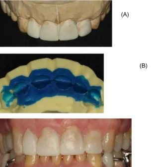 Figura 5- Preparo dental e instalação da prótese provisória nos 4 elementos. 