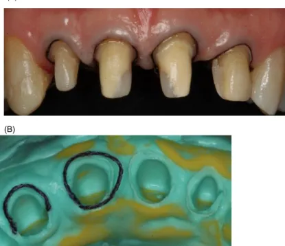 Figura 8- Preparos dentais finalizados. 