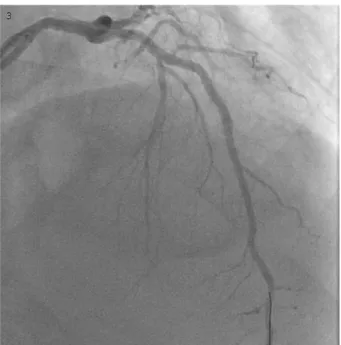 Şekil 1. Sol ön inen arter stent içerisinden orijin alan dev  psödoanevrizma ile uyumlu anjiyografi görüntüsü