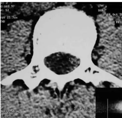 Figura 2 — Tomografia Computadorizada de Coluna Vertebral 14 Horas após o Início do Tratamento