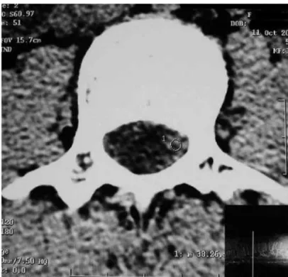 Figure 1 — CT Scan of the Spine Eight Hours after the Puncture