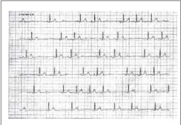 Figure 2 – Electrocardiogram with Prolonged D II  Derivation Showing Second Degree Atrioventricular Block Mobitz Type I