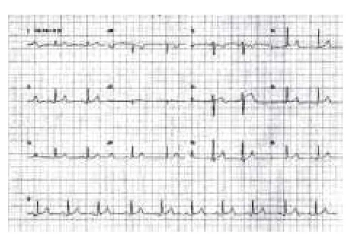 Figure 3 – Normal Electrocardiogram One Hour after Treatment