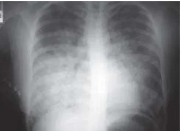 Figure 2 – Chest X-Ray 6 Hours after the Beginning of Symptoms.