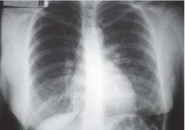 Figure 3 – Chest X-Ray 48 Hours after the Beginning of Symptoms.
