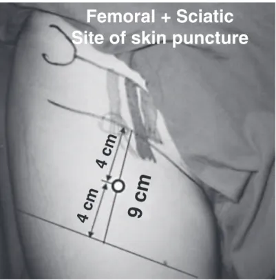 Figure 1 – Diagram for Insertion of the Needle.