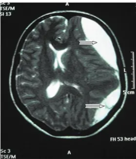 Figura 3 – Resonancia magnética del cráneo mostrando la reabsor- reabsor-ción de los hematomas 52 días después del diagnóstico.