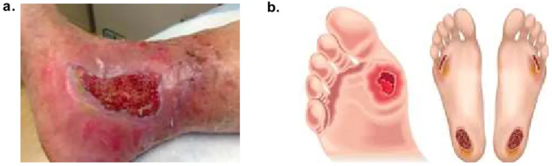 Figure 1.1  – Leg (a) and foot (b) chronic wounds  examples  (16,17). 