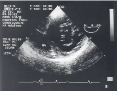 Figure 2. Transgastric Short Axis View, RV = right ventricle, LV = left  ventricle.