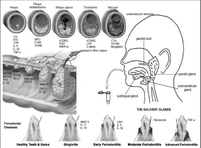 Figura 2- Biomarcadores aumentados na saliva durante a inflamação local (doença periodontal) e  durante a inflamação sistémica (no desenvolvimento da placa de aterosclerose nas artérias)