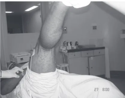 Table II shows the times to localize the nerves and the  depth of the needle for the tibial nerve, while Table III shows  the time to perform the blockades and the latency