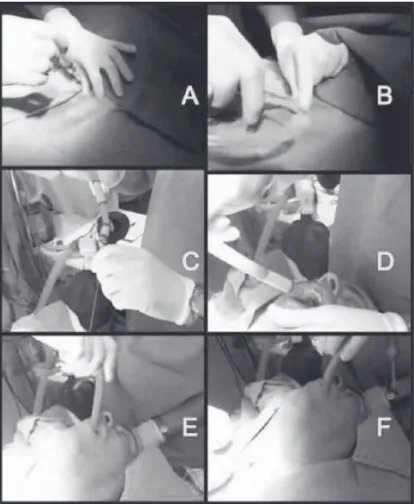 Figure 1 – Retrograde Selective Orotracheal Intubation.