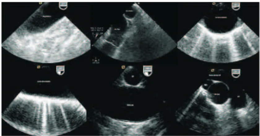 Figure 4  –  Main Cuts Obtained Through the Mid Esophagus.