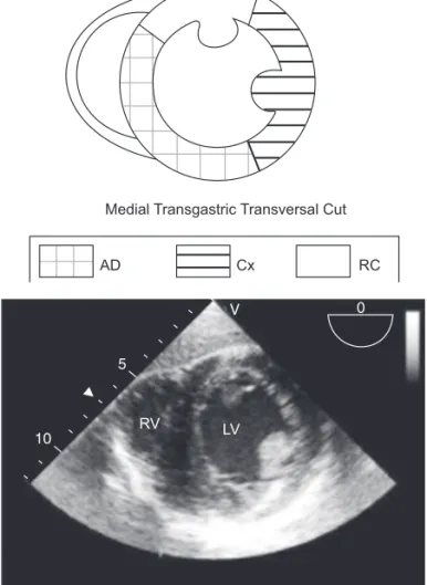 Figure 7  –  Medial Transgastric Transversal Cut of the Left Ventricle  Showing Areas of the Myocardium Irrigated by the Respective  Co-ronary Arteries