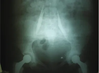 Figure 1 – Catheters Inside the Psoas Compartment.