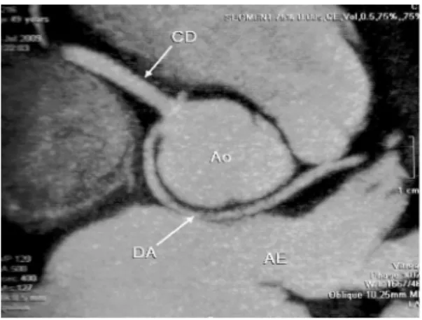 Figure 2 – CT Showing Left Coronary Artery (DA) Arising from Single  Coronary Ostium in Sinus of Valsalva (right)