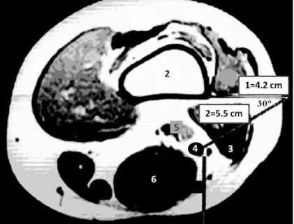 Figure 2. Member in External Rotation 47 o . Isciatic Blockade.