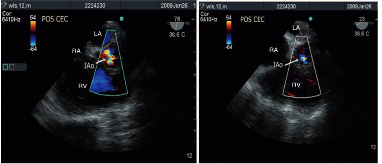 Figure 3 – Aortic Plan Short Axis with Multiplane Angle  in 76° (left) showing the result of control echo after the first attempt of repair, with residual  aortic insufficiency quantified as moderate and the same plan (right) showing a mild aortic regurgit