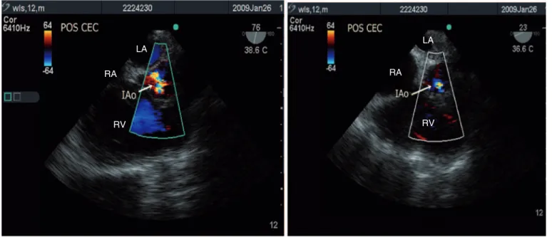 Figure 3 – Aortic Plan Short Axis with Multiplane Angle  in 76° (left) showing the result of control echo after the first attempt of repair, with residual  aortic insufficiency quantified as moderate and the same plan (right) showing a mild aortic regurgit